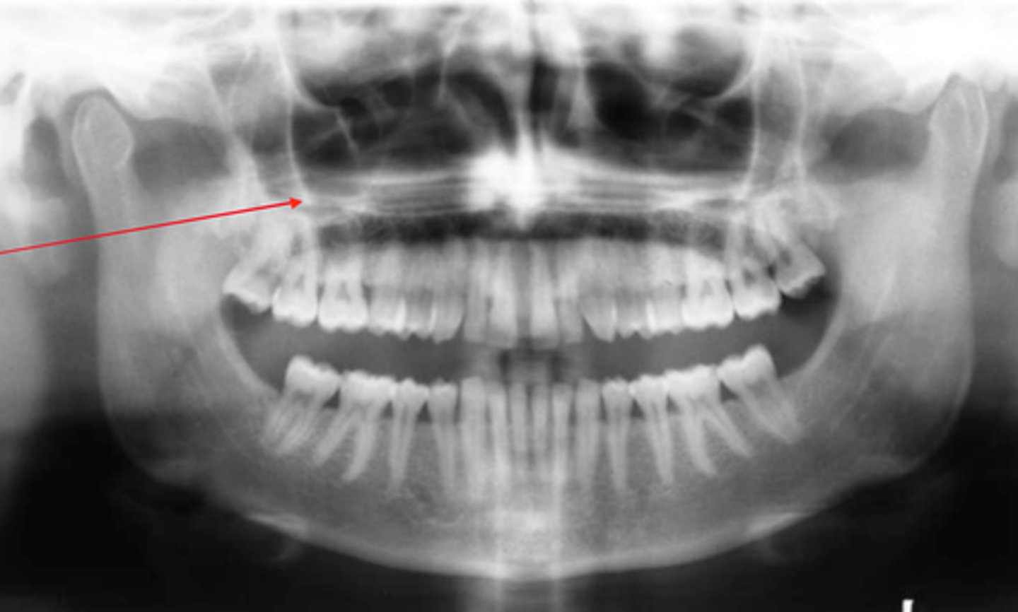 <p>Identify the radiopaque entity</p>
