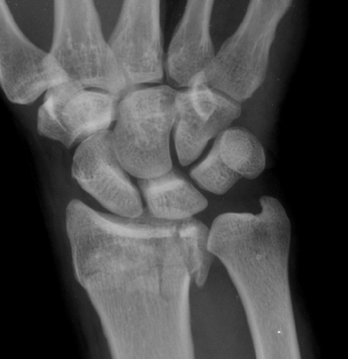 <p>When the fracture extends into the joint, this is ____</p>