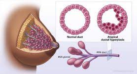 <p><span>The simple, straightforward definition would be "unusual," but "atypical" means much more than that. In a diagnosis, the use of the term atypical is a vague warning to the physician that the pathologist is worried about something, but not worried enough to say that the patient has cancer.</span></p>