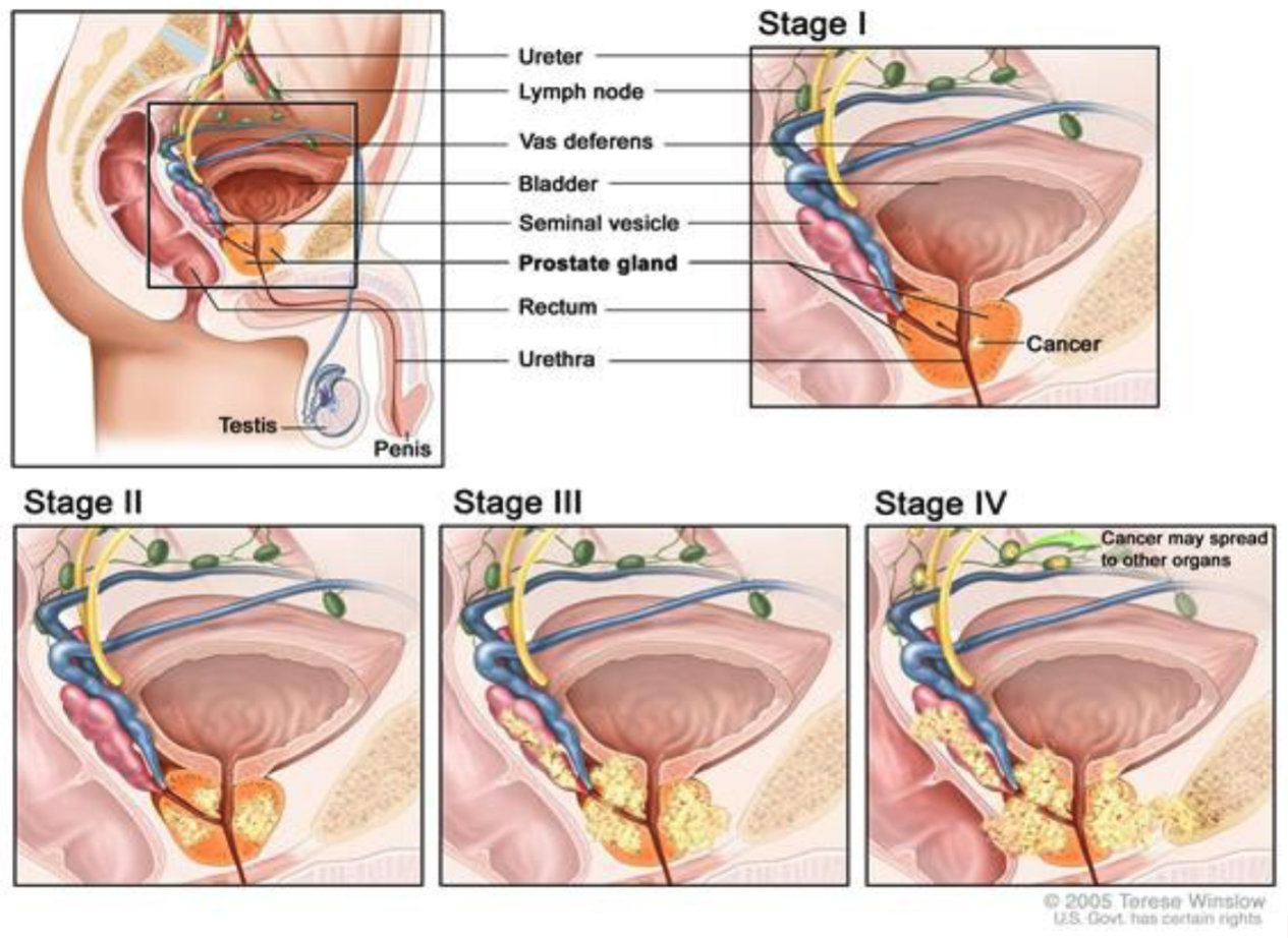 <ul><li><p><strong>Stage:</strong> TNM system (tumor size, lymph nodes, metastasis)</p></li><li><p><strong>Grade:</strong> <strong>Gleason score</strong>, based on how abnormal the prostate cells look</p></li></ul><p></p>