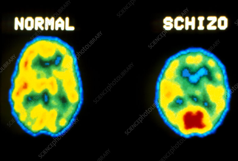 <ul><li><p><mark data-color="yellow">Positron emission tomography (PET)</mark> scan analysis of <mark data-color="yellow">dopamine</mark> usage indicates a greater number of receptors in the <mark data-color="yellow">striatum, limbic system and cortex</mark> of the brain in those with <mark data-color="yellow">schizophrenia</mark> than in those without.</p></li><li><p>Excessive <mark data-color="yellow">dopamine</mark> activity in these areas may be linked to <mark data-color="yellow">positive symptoms.</mark></p></li><li><p><mark data-color="blue">Nestler, 1997</mark> suggests that decreased <mark data-color="yellow">dopamine</mark> activity in the prefrontal cortex of <mark data-color="yellow">schizophrenia</mark> patients may correlate with <mark data-color="yellow">negative symptoms</mark> such as <mark data-color="yellow">flattened affect.</mark></p></li></ul>