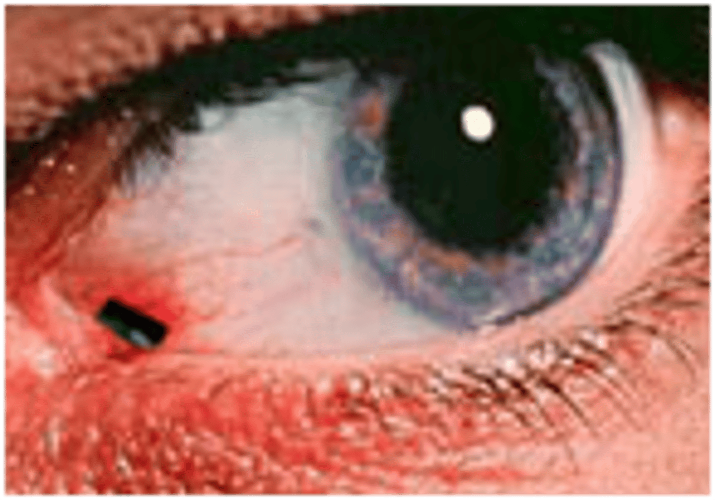 <p>Ocular Foreign body</p>