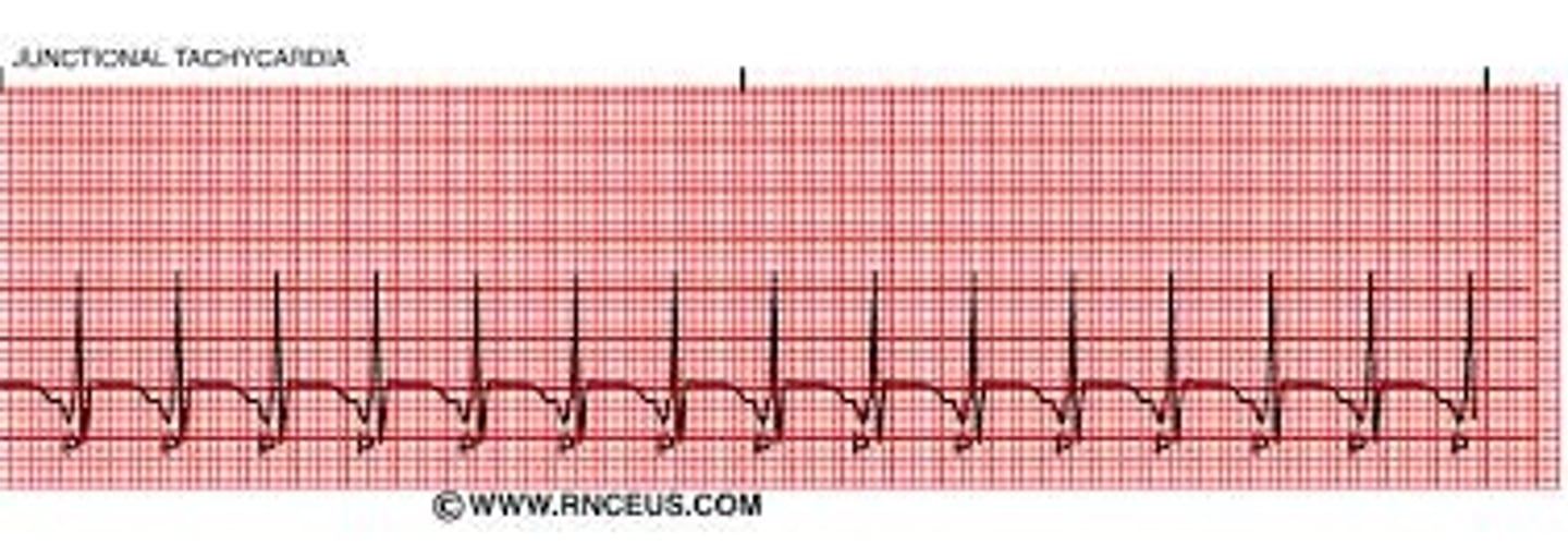 <p>1. P-P and R-R intervals are regular and similar; P-P interval may be difficult to determine due to location and increased HR 2. Ventricular and Atrial rate: 100-180 bpm 3. P wave: usually inverted; may follow, precede, or fall within QRS; may not be visible on rhythm strip; may need increased paper speed on cardiac monitor 4. PR interval: before the QRS: less than 0.12 second and constant 5. QRS complex (WNL)</p>