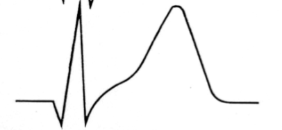 T wave elevation in the affected leads, which can appear within minutes of the onset of the infarction.
