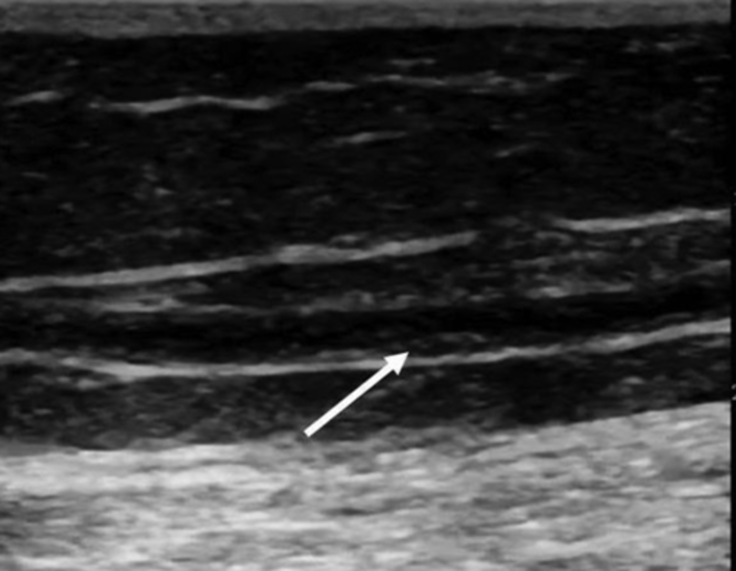 <p>Irregular intimal surface</p><p>Cannot be used for arterial bypass</p>