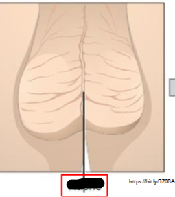 <p>What is this within the Scrotum?</p>