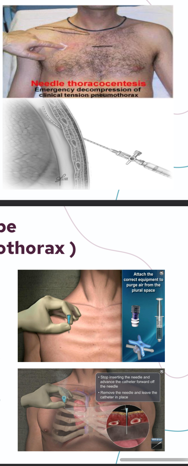 <ul><li><p>Chest tube insertion with underwater seal for clinically unstable patients</p></li><li><p>If chest tube insertion is delayed, <strong>decompression</strong> can be preformed by placing needle into the pleural space at the midclavicular line opposite the second intercostal space at the lower border of the intercostal space</p></li></ul><p></p>