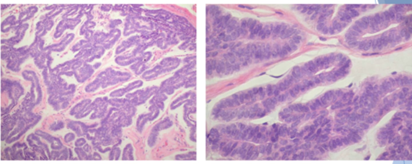 <p>ID the pathology based on the histology findings:</p><p>- Encapsulated or well-circumscribed</p><p>- Parallel cords of single cuboidal cells</p><p>- Forming double row "canals" with central lumina</p>