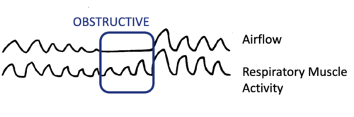<p>No airflow due to upper airway obstruction.</p>