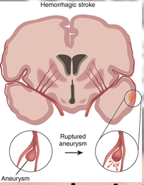 <p>intraaxial: hemorrhage inside the brain </p><p>extraaxial: hemorrhage outside the brain</p><p></p>