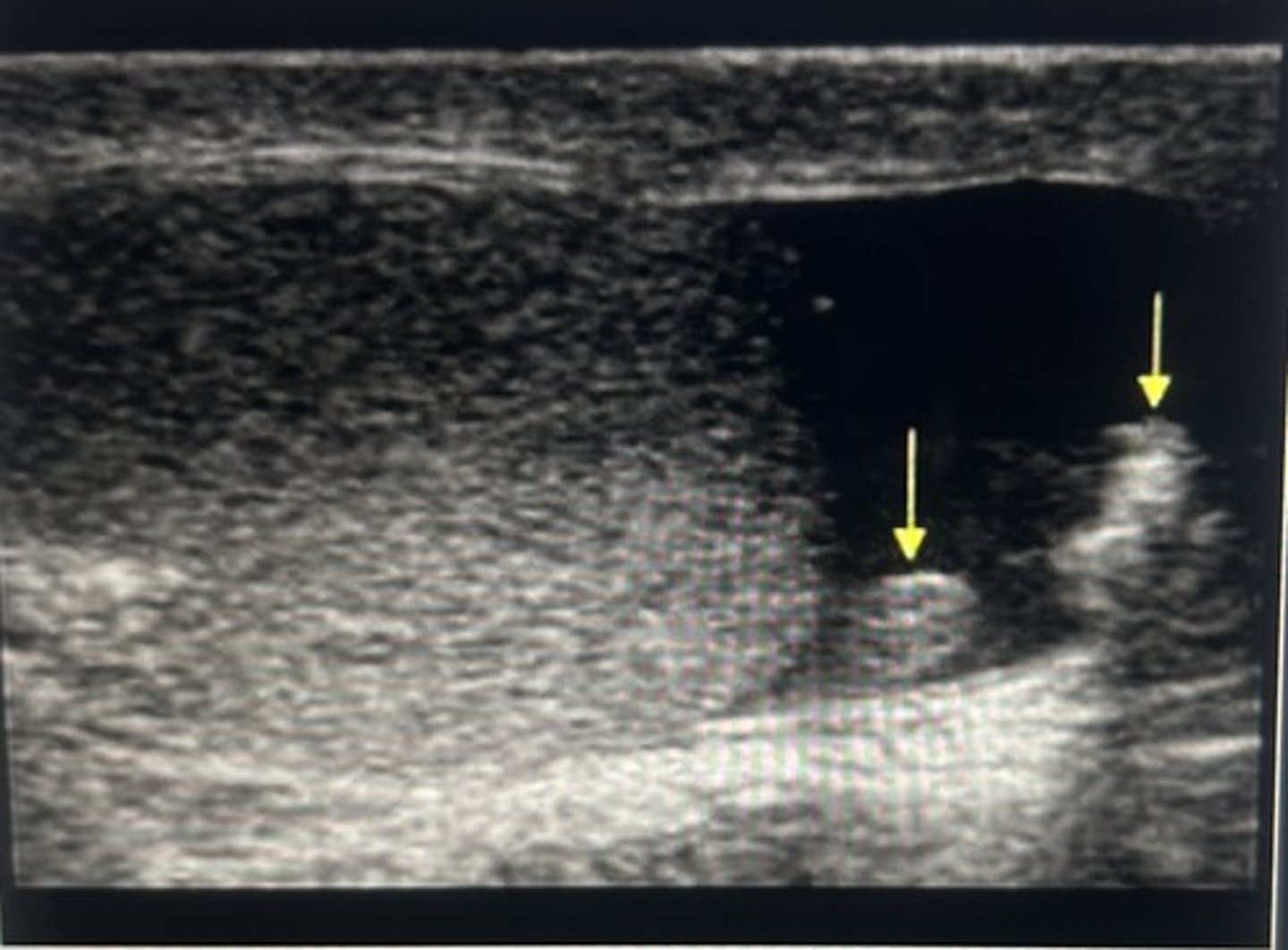 <p>The arrows indicate a remnant of the Mullerian duct and scrotal calcification</p>