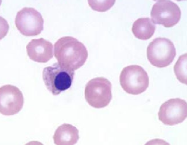 * metarubricytes or earlier erythroid precursors
* Low #s are appropriate during regenerative anemia or hypoxia
* Seen in piglets <3 wks old 


* If seen w/o retics something is wrong
* Causes: Lead toxicity, Iron deficiency, Copper deficiency, Hemangiosarcoma, EMH, Myelophthisis, IVD, Hereditary macrocytosis of poodles, Endotoxemia, BM trauma or necrosis, Mets to the BM, Myelofibrosis, FeLV, Myelodysplastic syndrome
* Basophilic cytoplasm bc they still have organelles, trying to make      Hb
* Complete rim of cytoplasm
* Coarser chromatin