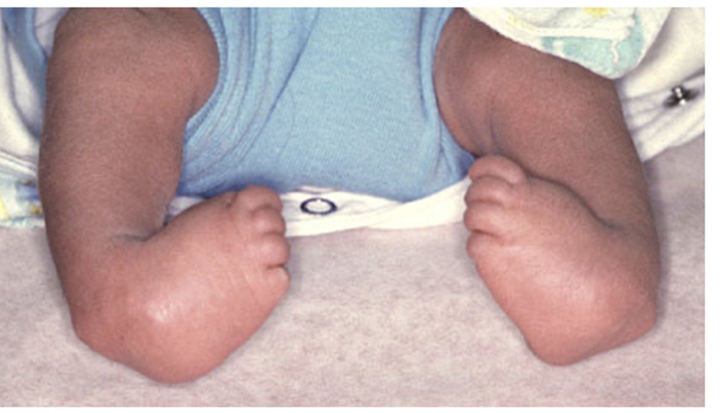 <p>One of the most common pediatric orthopedic conditions</p><p>•Treated by manipulation, casting, surgery</p>