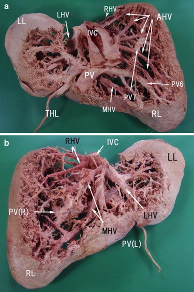 <p>A blood vessel that carries deoxygenated blood away from the liver and towards the inferior vena cava</p><p>Just DEEP to and THINNER than artery</p>