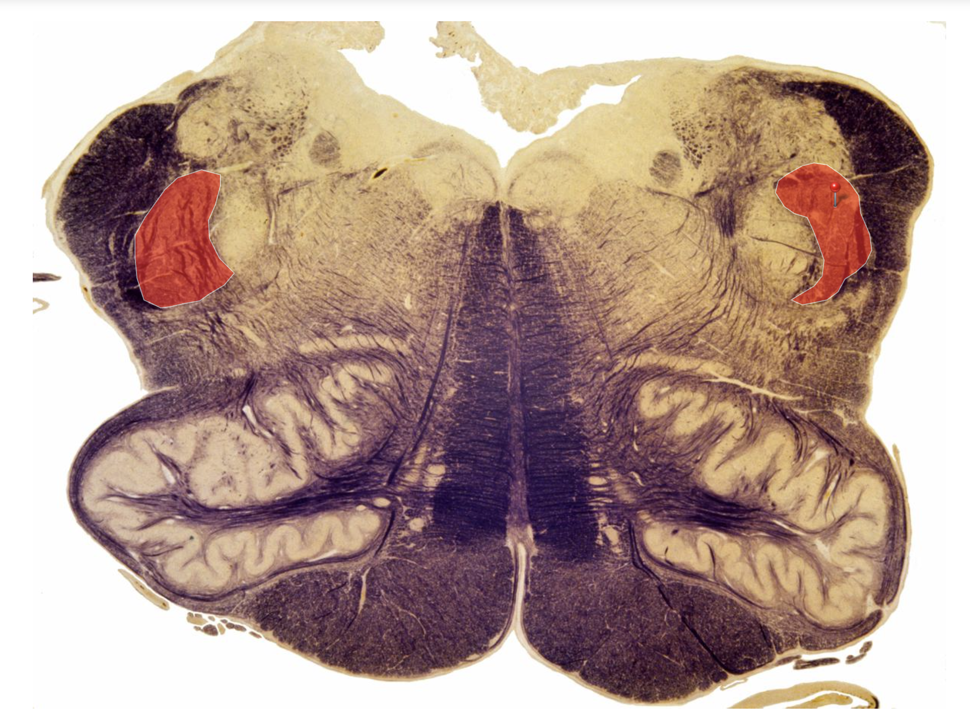 <p>Spinal Trigeminal Tract </p><p></p><p>Transporting P&amp;T from the Face to spinal trigeminal nucleus via STT</p>