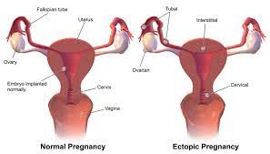 <p>Ectopic pregnancy</p>