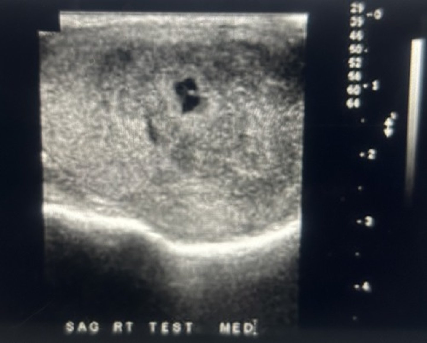 <p>These tumors are more common in men, age 20 to 30 years old</p>
