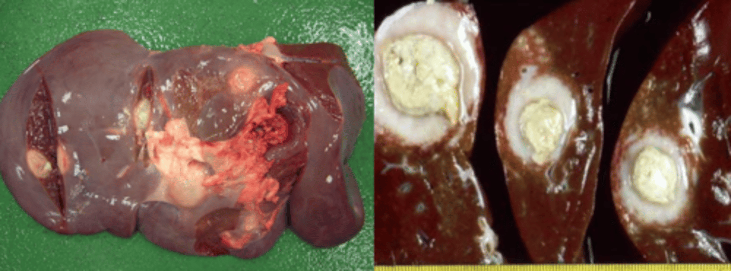 <p>these hepatic abscesses occurred because....</p>