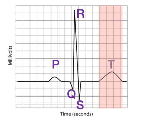 <ul><li><p>P wave</p><ul><li><p><span>This electrical event is the result of </span><strong>DEPOLARIZATION</strong><span> of the atria of the heart. Please remember this is not measuring a single action potential but the sum of all action potentials occurring in the atria. If you were to measure the time from the start of 1 P wave to the next P wave, you could determine heart rate.&nbsp;</span></p></li></ul></li><li><p>QRS wave</p><ul><li><p>This electrical event is the result of the <strong>DEPOLARIZATION</strong> of the ventricles. Notice how much larger it is than the P wave. This is because the ventricles have a much larger mass and, therefore, more cells than the atria. With more cells comes a larger electrical event.</p><p></p><p>Measurements of the time it takes from the P wave to the start of the QRS wave (PR interval) can indicate whether electrical conduction is normal between the atria and ventricles. Other measurements, like the Q-T interval, can give indications about cardiac conditions. There are a variety of measurements that are done that are beyond the scope of this course.</p></li></ul></li><li><p>T wave</p><ul><li><p>This electrical event is the result of the <strong>REPOLARIZATION</strong> of the ventricles.&nbsp;</p><p></p><p>It is important to point out that repolarization is also "up" in the ECG. During the action potential, you have always seen repolarization as making the voltage of a cell more negative. In fact, all three of these waves (P, QRS, and T) have an upward (more positive) and then downward (more negative) component. That is because the <strong>direction of the wave (up or down) is determined by the direction of the electrical activity toward a particular electrode.</strong> If the electrical activity is heading toward that electrode, it is shown as an increase in voltage. As that electrical activity is heading away from that same electrode, it measures a decrease in voltage. It is more complicated than this, but hopefully this makes sense. In other words, do not confuse what is seen in the ECG to what you learned about for action potentials. Again, these are not individual action potentials.</p></li></ul></li></ul><p></p>