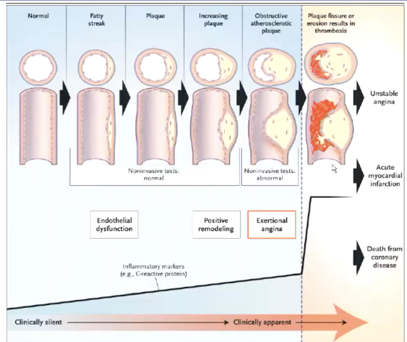 <p>coronary artery disease (CAD)</p><ul><li><p>70%+ blockage has hemodynamic effects</p></li></ul><p></p>