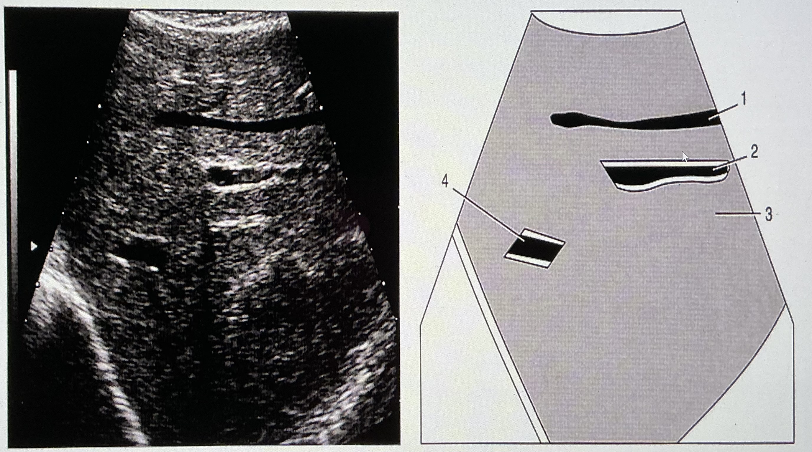 <p>Which numbers on the diagram/image indicate portal venous structures?</p>