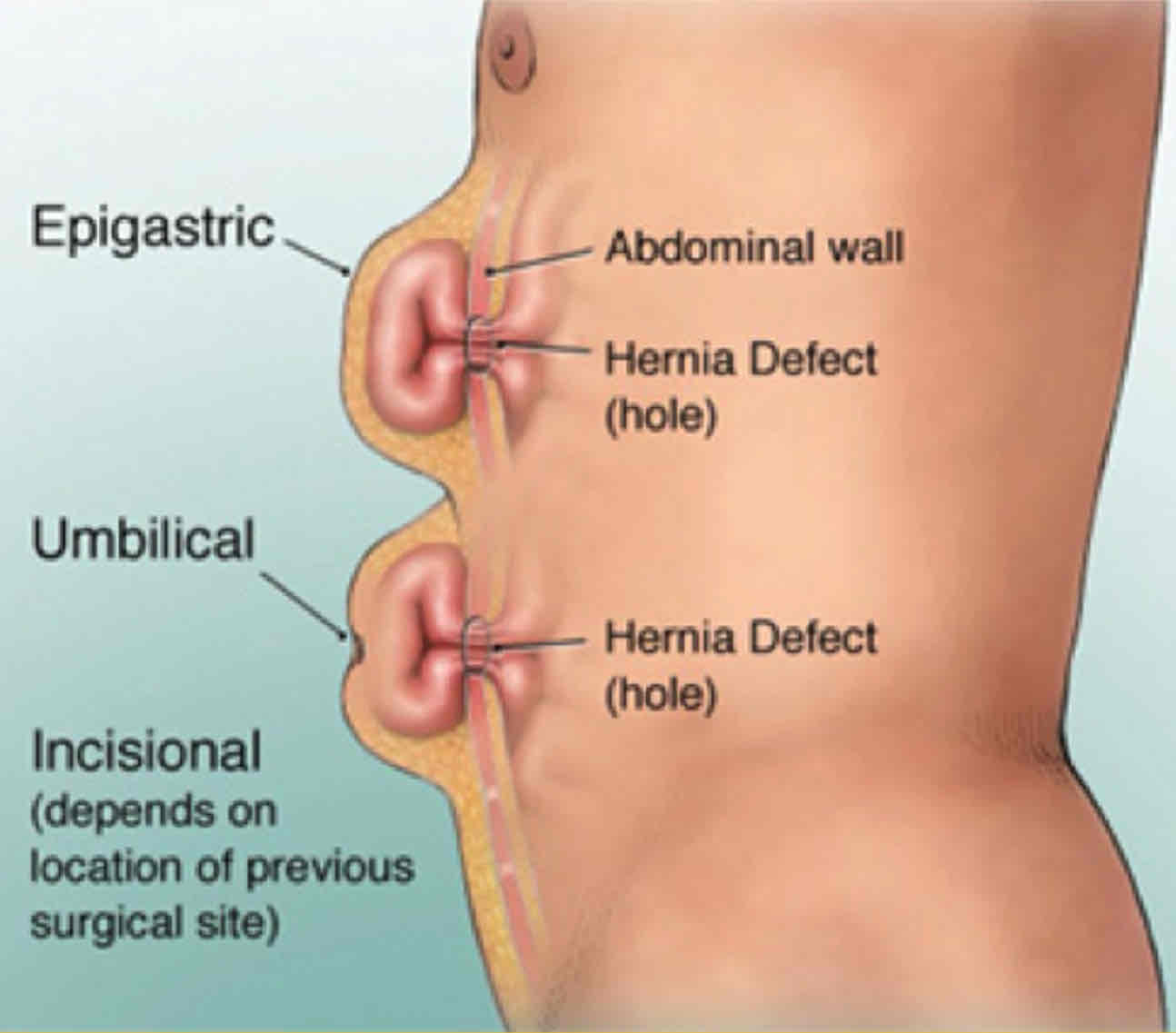 <ul><li><p>Epigastric </p></li><li><p>Umbilical</p></li></ul><p></p>