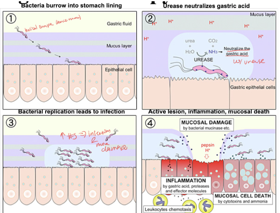 <ul><li><p><span style="background-color: transparent; font-family: &quot;Times New Roman&quot;, serif;">Bacterial burrow into stomach lining, urease neutralizes gastric acid with urease, bacteria replication leads to infection and more damage, active lesion inflammation and mucosal death</span></p></li></ul><p></p>