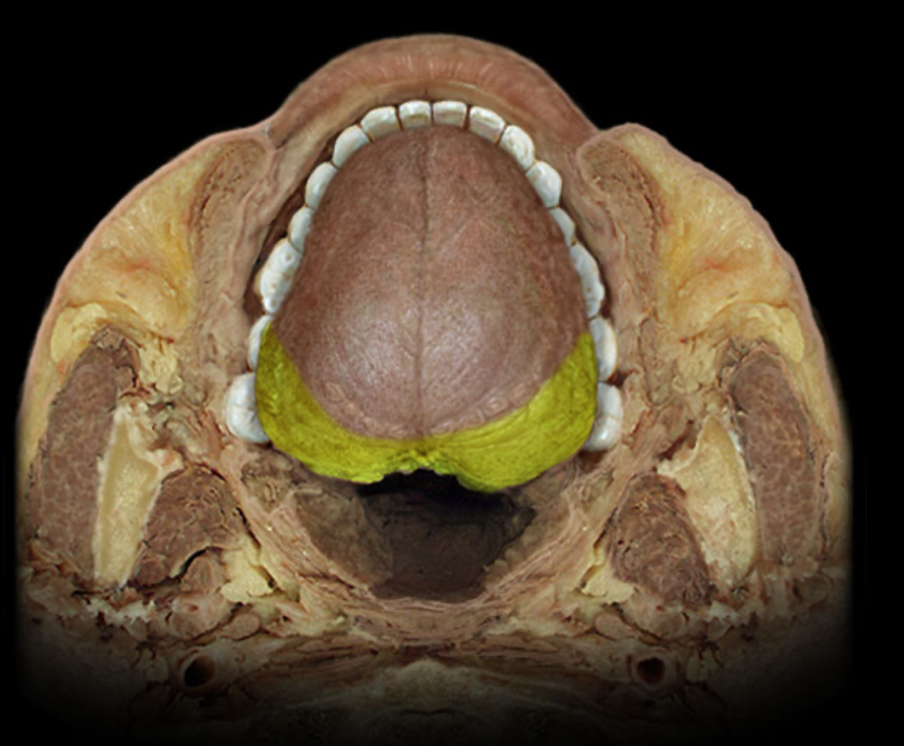 <h4 collapsed="false" seolevelmigrated="true"><strong>Location:</strong></h4><ul><li><p>Middle ear</p></li><li><p>Posterior 1/3 of tongue</p></li><li><p>Pharynx</p></li></ul><h4 collapsed="false" seolevelmigrated="true"><strong>Comment:</strong></h4><ul><li><p>General sensation includes pain, touch, and temperature</p></li></ul>