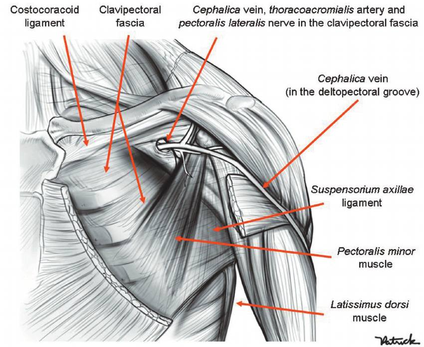 <p>The clavipectoral fascia is penetrated by which artery?</p><p>A. Anterior circumflex humeral</p><p>B. Axillary</p><ul><li><p>runs beneath the fascia</p></li></ul><p>C. Subscapular</p><p><strong><mark data-color="red" style="background-color: red; color: inherit">D. Thoracoacromial</mark></strong></p><ul><li><p>branch of axillary artery</p></li><li><p>Also penetrated by:</p><ul><li><p>cephalic vein</p></li><li><p>lateral pectoral n.</p></li><li><p>lymphatic vessels</p></li></ul></li></ul><p>E. Thoracodorsal</p><ul><li><p>supplies latissimus dorsi</p></li></ul><p></p>