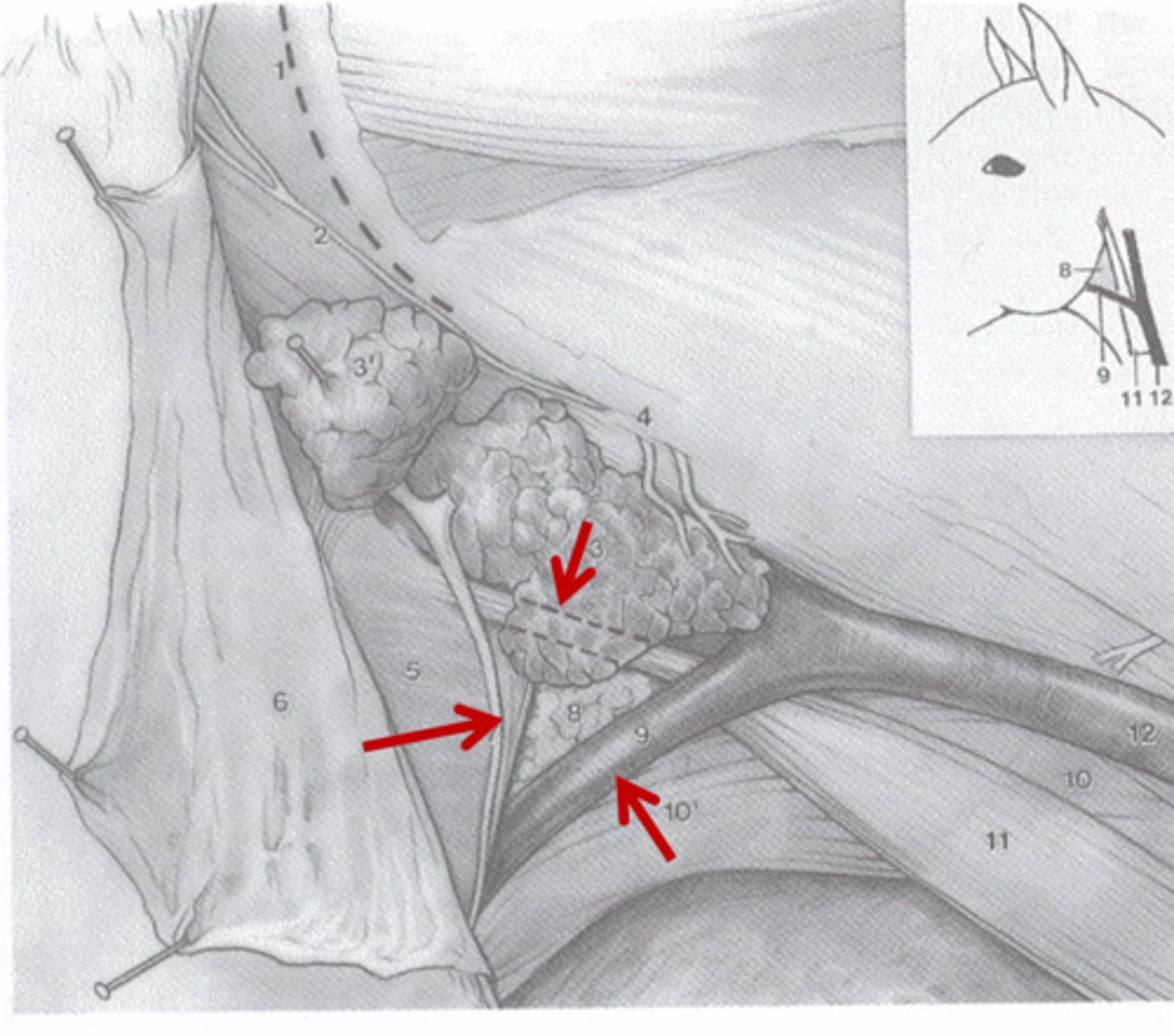 <p>- Linguofacial v., caudal border of the mandible, and the sternocephalicus tendon (sternomandibularis)</p><p>- Surgical landmark for access to an enlarged guttural pouch, normal guttural pouches do not extend this far ventrally</p>