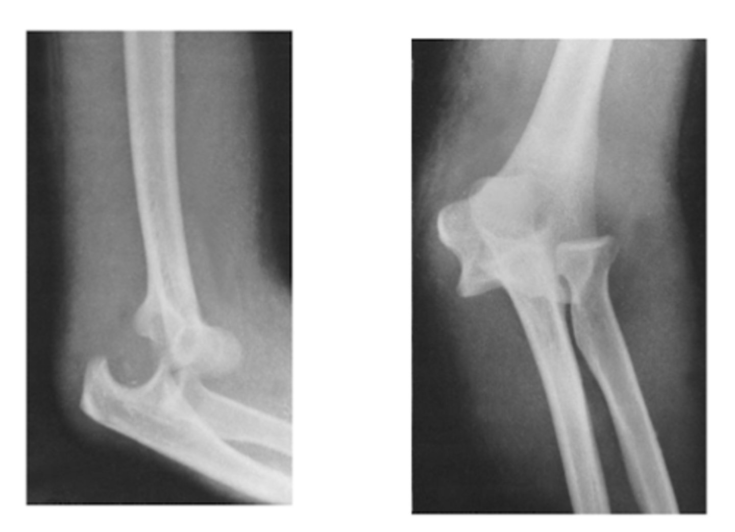 <p>posterolateral</p>