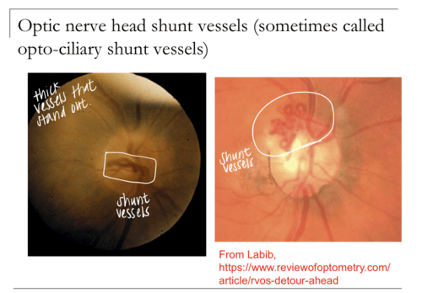 <p>Optic nerve head shunt vessels -- Opto-ciliary shunt vessels (Pic)</p>