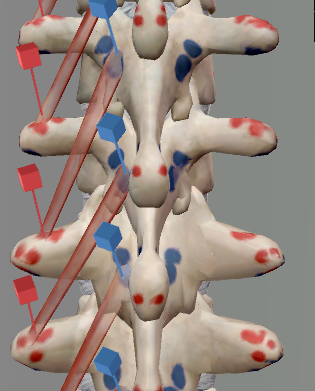 <p>Origin: Transverse process of each thoracic vertebra</p><p>Insertion: Spinous process of the vertebra two above each origin</p><p>Innervation: Cervical, thoracic, and lumbar nerves (posterior branch)</p><p>Action: Rotation of the thoracic spine; extension of the spine; contralateral rotation of the head</p>
