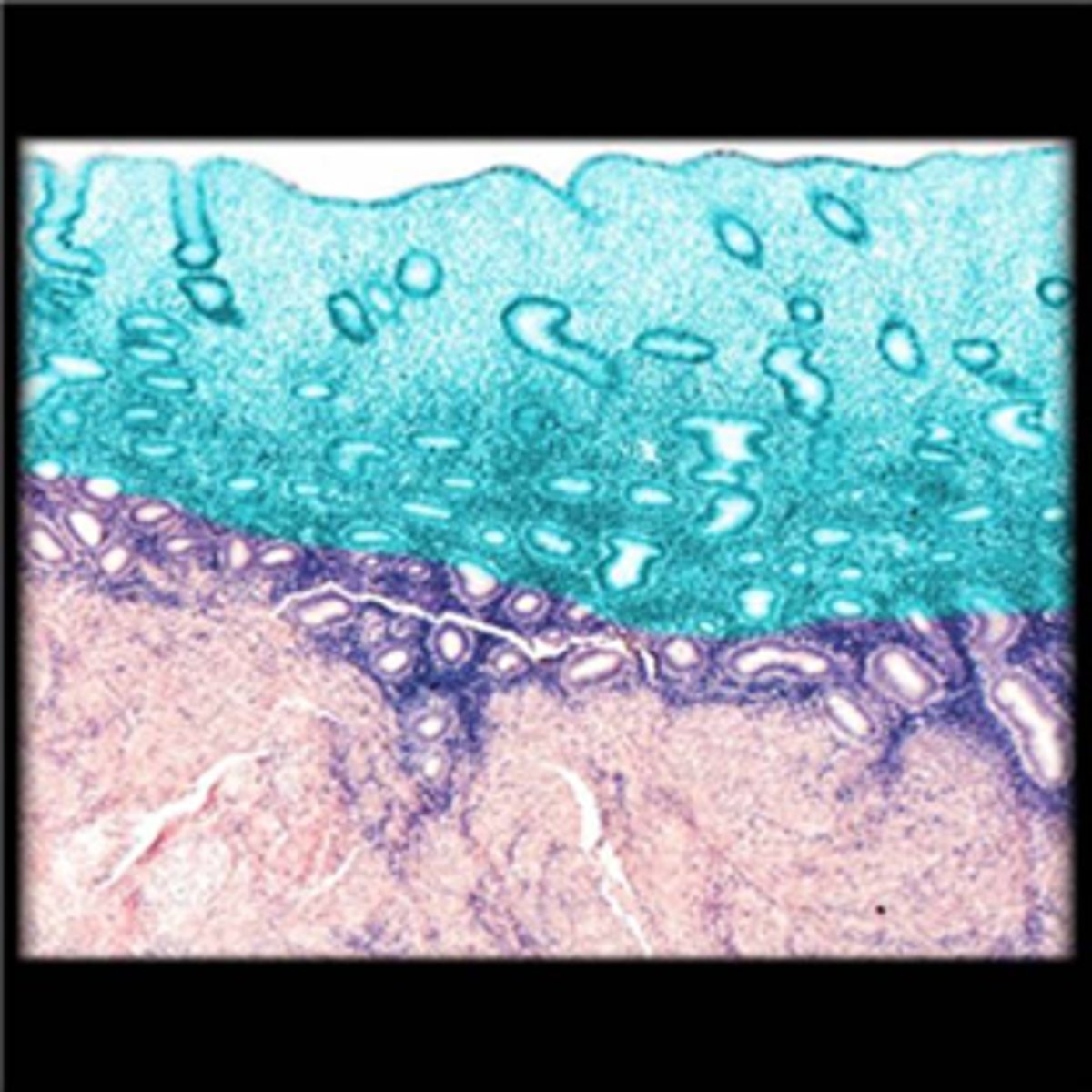<p>upper 2/3rds of mucosa</p>