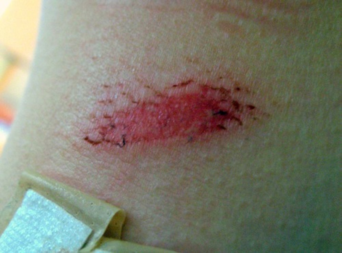 <p>A wound caused by superficial damage to the skin</p>