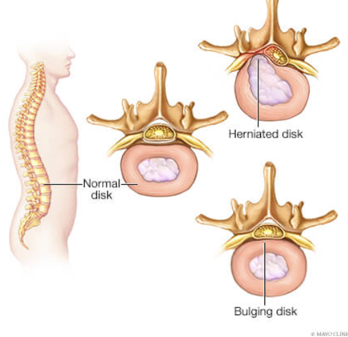 <p>nerve root compression resulting from narrowing of intervertebral forearm </p><p>can occur with fractures, OA, or thinning of intervertebral disks</p><p>leads to sensorimotor deficits in muscles or dermatomes in nerve roots</p>