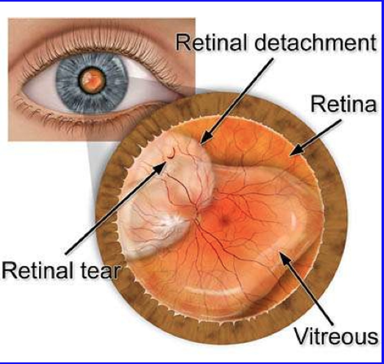 <p>adj. thuộc võng mạc</p><p>ex: Prolonged exposure to bright light can cause retinal damage.</p>