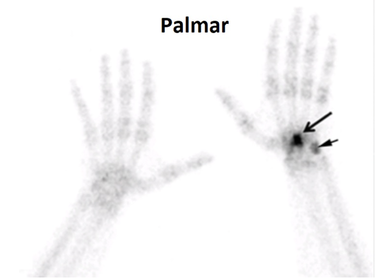 <p>Below is a bone scan image. The patient has a fracture on one of their wrists as indicated by the arrows.</p><p>Which wrist is the one with the fracture?</p>