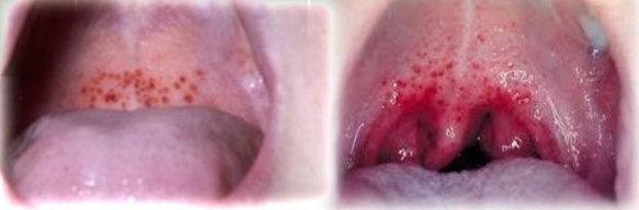 <p><strong><u>Petechiae, Ecchymosis, Hematoma</u></strong></p><p class="has-focus">If multiple lesions, must exclude:</p><p class="has-focus">Child abuse</p><p class="has-focus">Bleeding disorders</p><p class="has-focus">Infectious mononucleosis + other viral infections</p><p class="has-focus"></p><p class="has-focus is-empty"><strong>No treatment</strong> - spontaneously resolve</p>