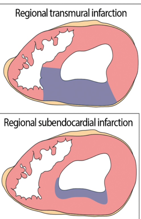 <p>subendocardial </p>