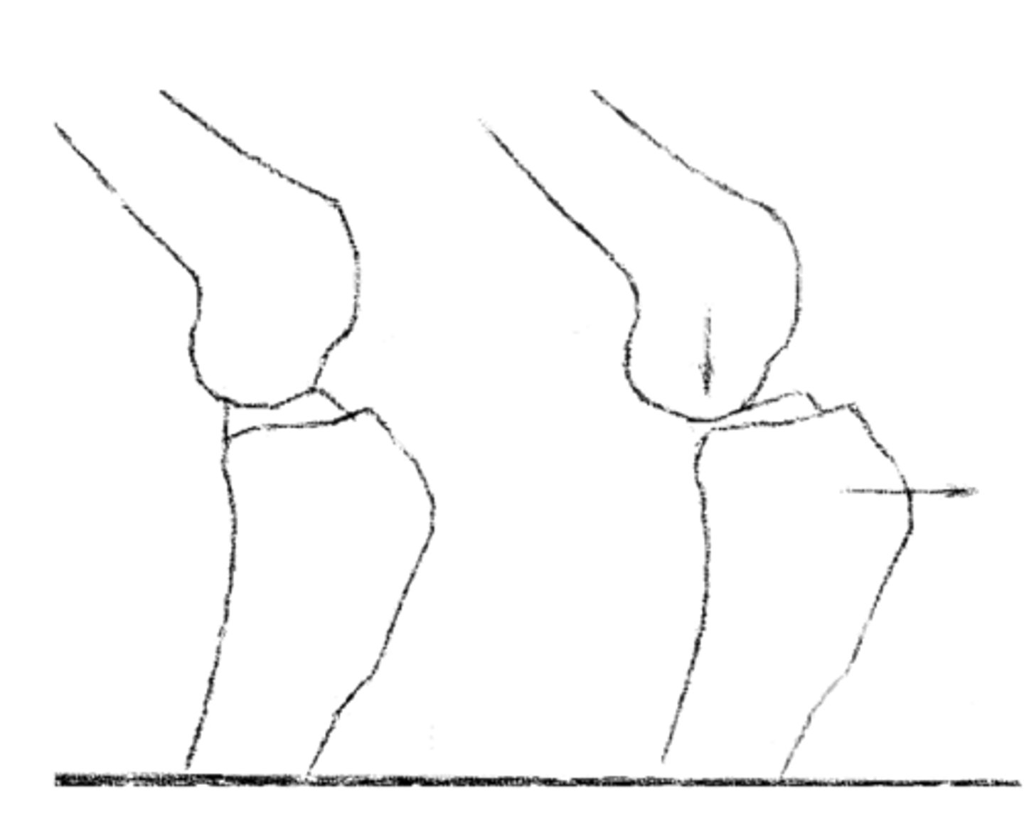 <p>how does meniscus actually suffer damage during weight bearing....</p>