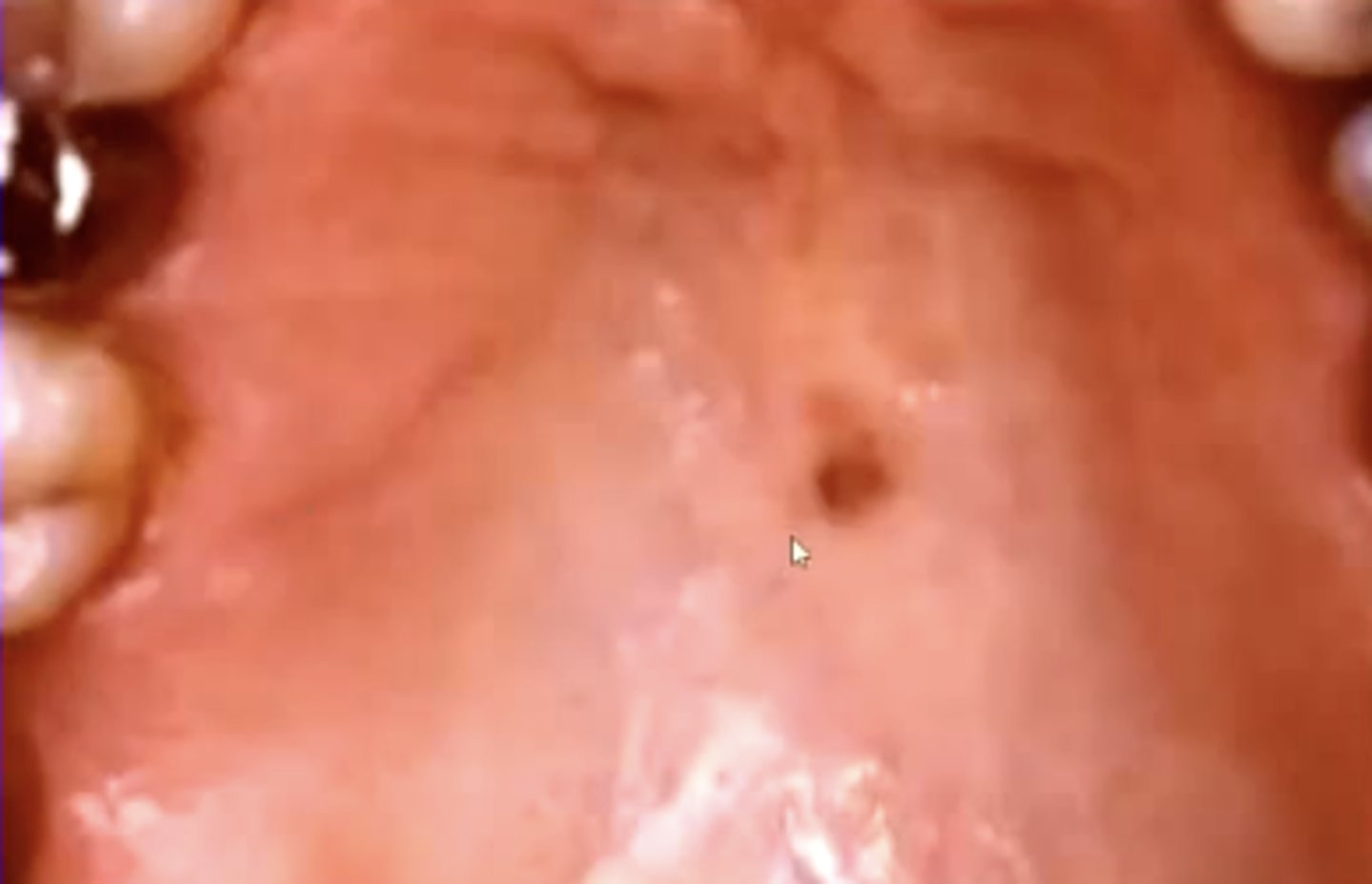 <p>flat, brown mucosal lesion possibly due to trauma</p><p>basically like a freckle in the mouth</p>