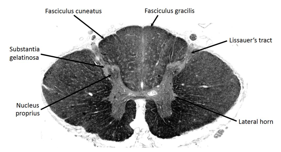 <p>upper thoracic (T6)</p>