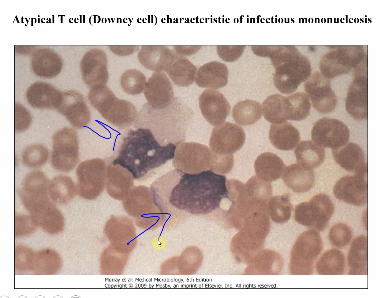 <p><u>Symptoms</u>:</p><ul><li><p>mild headache, fatigue, fever</p></li><li><p><em>Triad</em>: </p><ul><li><p>Lymphodenopathy</p></li><li><p>Splenomegaly</p></li><li><p>Exudative Pharyngitis</p></li></ul></li><li><p>Other:</p><ul><li><p>hepatitis</p></li><li><p>ampicillin-induced rash</p></li></ul></li></ul><p><u>Complete Blood Cell Count</u>:</p><ul><li><p>hyperplasia</p></li><li><p>atypical lympocytes (downey cells)</p></li></ul><p><u>Heterophile Antibody</u> (transient)</p><p><u>EBV-antigen specific antibody</u></p><p></p>