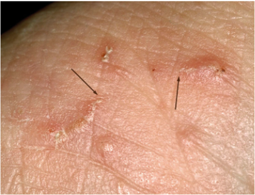 <p>slightly raised tunnel in epidermis; ex- scabies</p>