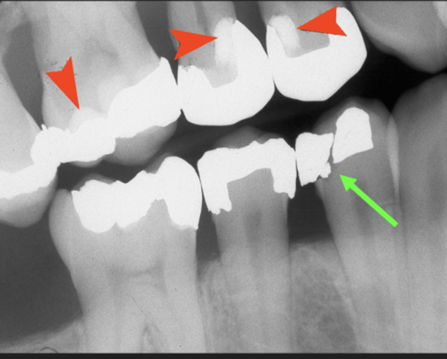 <p>- Bases - underneath fillings, or as a temporary filling material-protect pulp</p><p>- &gt; Varying shades of radiodensity</p>