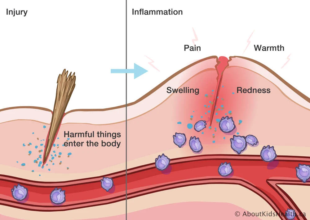 <p>Inflammation is initiated by what?</p>