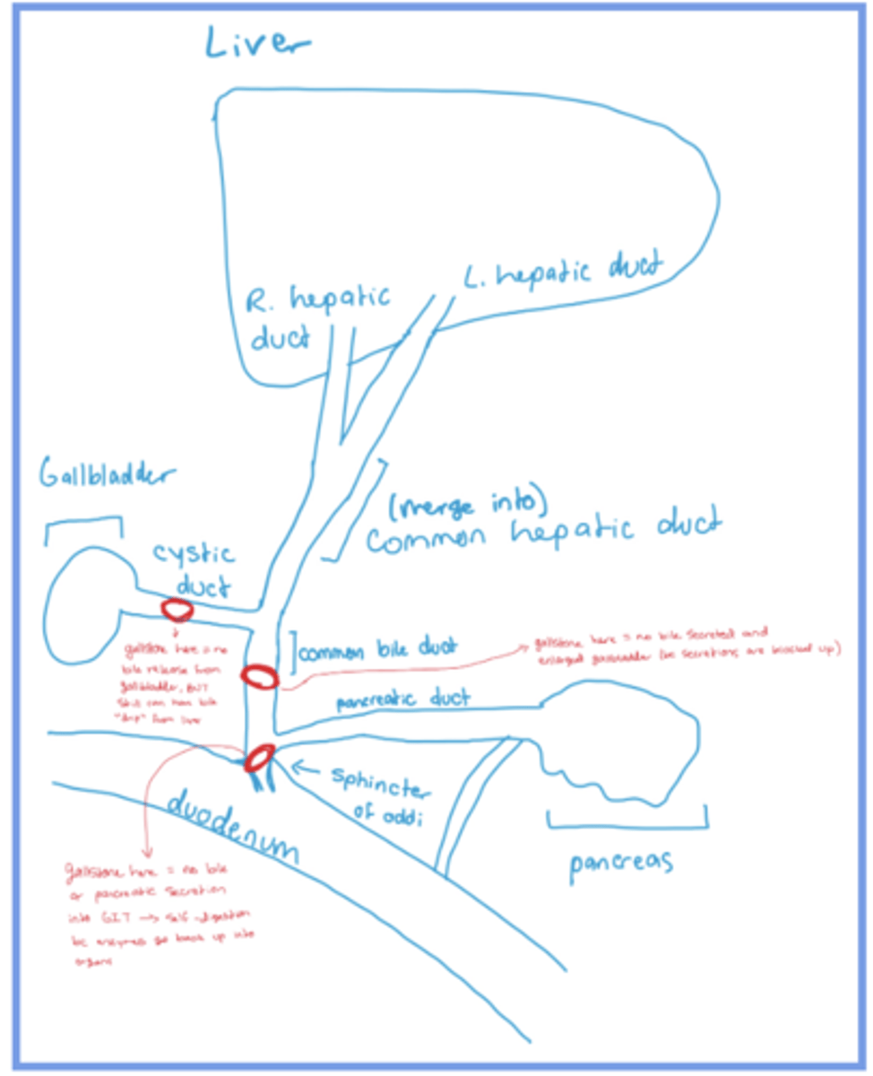 <p>what would a gallstone at each of the red circles cause?</p>