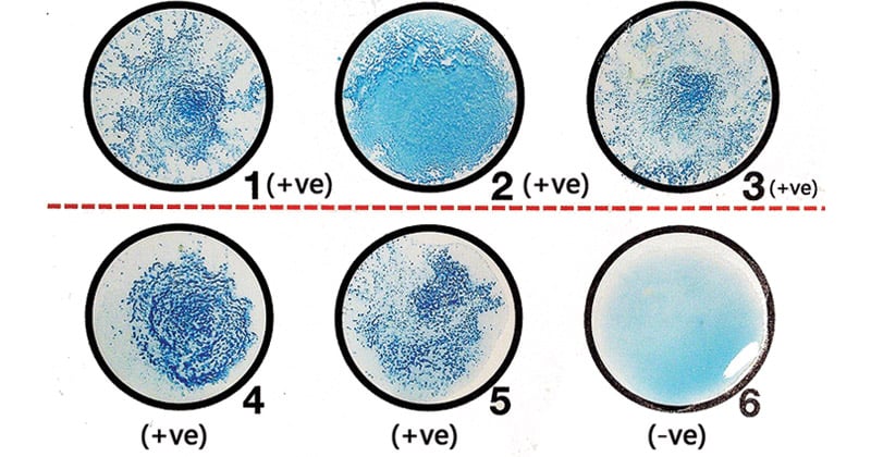 <p>makes use of small, spherical, latex particles that are coated with antigen and suspended in water. If serum that contains the corresponding antibody is added to the mixture, the formation of antibody-antigen complexes causes agglutination (clumping). Agglutination changes the appearance of the latex suspension from smooth and milky to clumpy because the latex particles have clustered and cross-linked together. If no antibody is present in the sample, the mixture of latex and serum remains evenly dispersed. The strength of reaction can be graded (i.e., +1, +2, +3, or +4) to provide an indication of the amount of antigen present. One common test that uses this method is the test for<u> bovine brucellosis antibodies</u>. It is important to note that false negatives can occur when excessive amounts of antigen or antibody are present in the sample. In the presence of excess antibody, it is possible that each antibody molecule binds with only one or two antibodies and does not cross-link so that agglutination does not occur. This is known as the <u>prozone phenomenon</u>. Excess antigen can result in lack of cross-linking when the excess antigen surrounds any small clumps that may form. This is known as the <u>postzone phenomenon</u>. It is important to note that prozone and postzone phenomena can occur due to the characteristics of the patient sample or can occur due to errors in test performance such as improper pipetting techniques that result in inappropriate quantities of reagent added to the test system.</p>