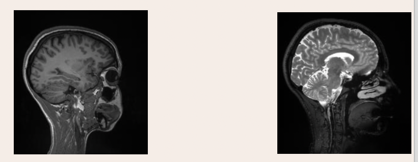 <p>which image is T1 weighted and which image is T2 weighted</p><ul><li><p>what are each respectively better for </p></li></ul><p></p>